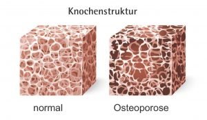Seiten-aus-Osteoporose-und-Ernährung-87-2-300x175 Osteoporose und Ernährung