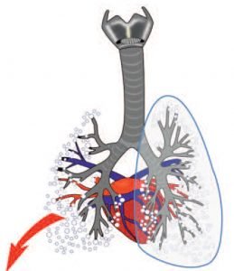 Exarzerbation-bei-COPD-4-300x182 Symptomatische Verschlechterung bei COPD