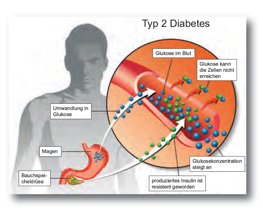 cukorbetegség tünetei gyógyszeres kezelése rohamok kezelésére láb, ha van a diabétesz