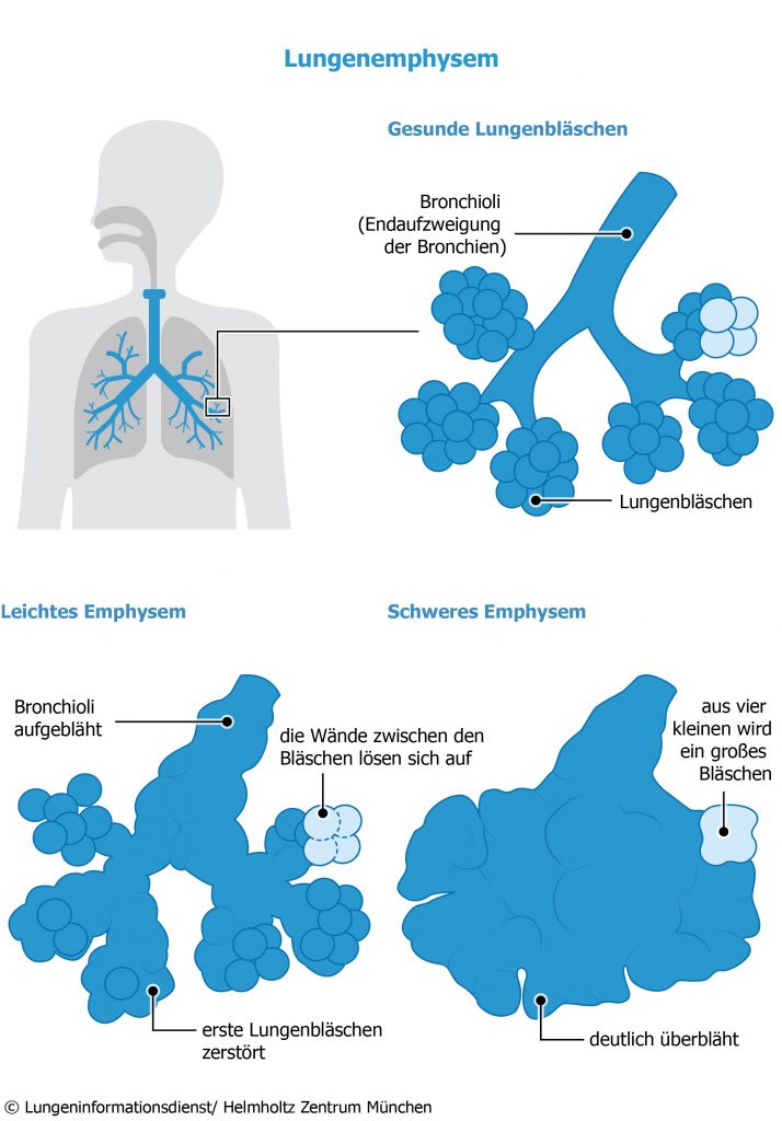 Lungenemphysem-LID-714x1024 Atemnot durch Lungenüberblähung