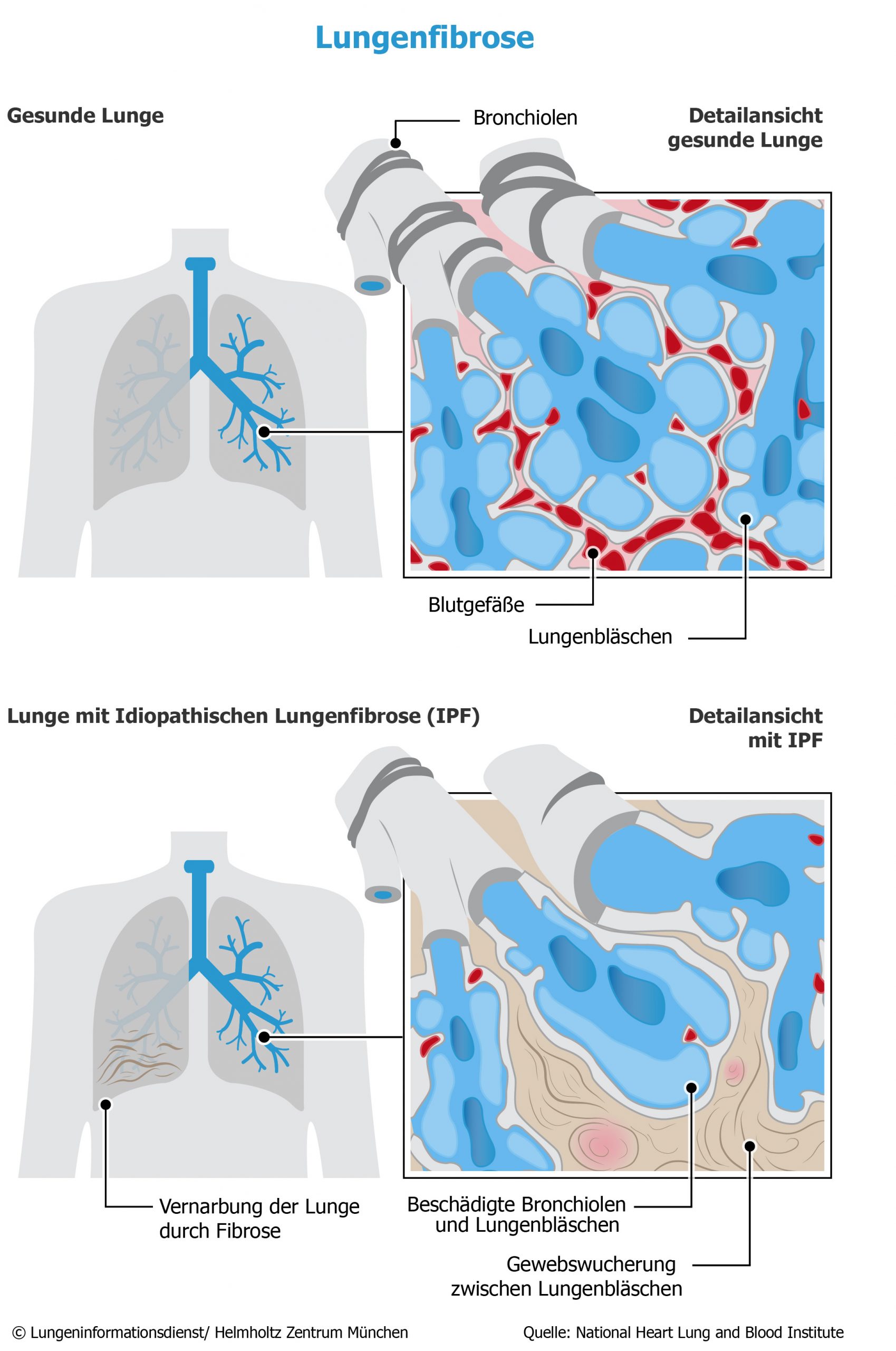 Lungenfibrose_LID PatientenBibliothek gGmbH