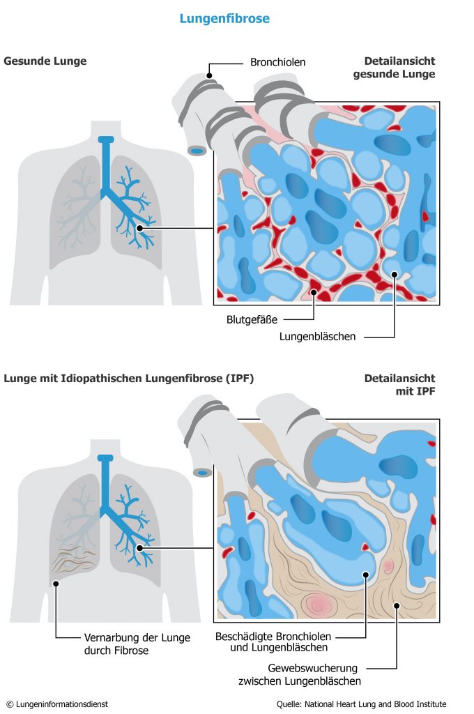 Lungenfibrose_Lungeninformationsdienst-680x1024 Lungenfibrose
